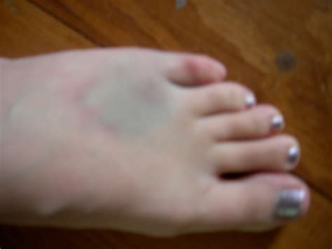 The little toe (pinky) is the most common toe fractured. Life Less Ordinary: Week 3 of Unemployment: (Almost ...