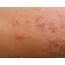 Widespread Skin Rash Following Travel To South East Asia  BMJ Case Reports