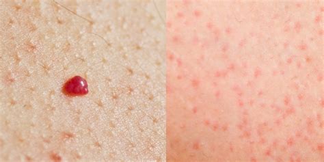 Red Bumps On Skin Keratosis Pilaris How To Get Rid Of Chicken Skin
