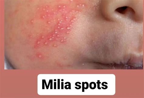 Milia Spots Medizzy