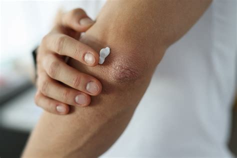 Psoriasis 101 Overview Symptoms Causes And Treatment Homage