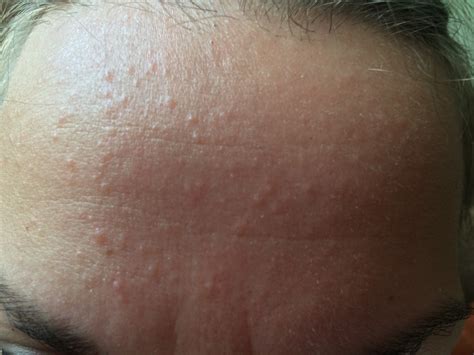 Small Flesh Colored Bumps On Forehead And Hairline Adult Acne Acne Org Forum