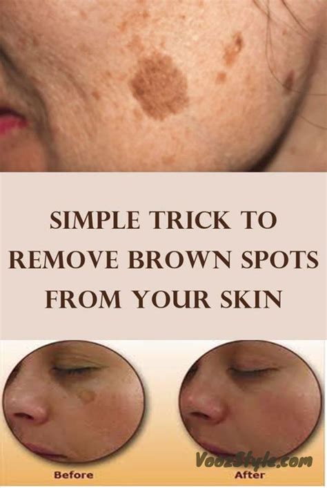 Simple Trick To Remove Brown Spots From Your Skin