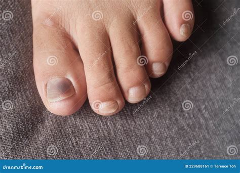 Close Up View Of A Toe Nail With Purple Discoloration Due To An Injury