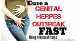 Pictures of Holistic Cure For Genital Herpes