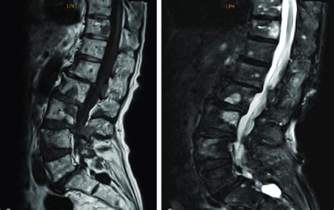 MRI Showing Multiple Spinal Lesions With Low Intensity On T1 Weighted