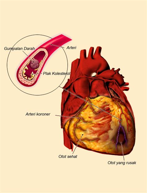 Selain terjadi pada penyakit paru, sesak napas adalah salah satu gejala yang juga sering terjadi sebagai tanda awal penyakit jantung. Abdunwijaya: Tanda-tanda, Tips dan Cara Mengatasi Serangan ...
