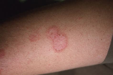 Susie Luna Rumor Red Circle On Skin Not Itchy Lupus
