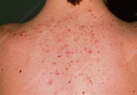 Acne Vulgaris On The Back Of A Young Man Stock Image M1080235