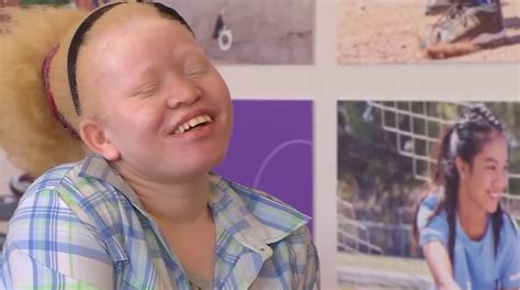 Albino Girl Whose Leg And Fingers Were Chopped Off Because Of Her Skin
