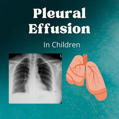 Pleural Effusion Or Fluid Inside The Chest In Children Causes