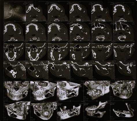 Preoperative Panoramic Radiograph A And Computed Tomography Scan B