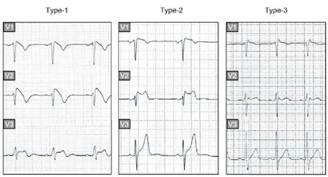 Three Different Ecg Patterns In Right Precordial Leads Frequently