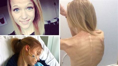 Cae En La Anorexia Inspirada En Selfies Que Muestran La Enfermedad