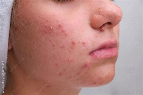 Acne Teenage Girl With The Pimples On Her Face Problematic Skin