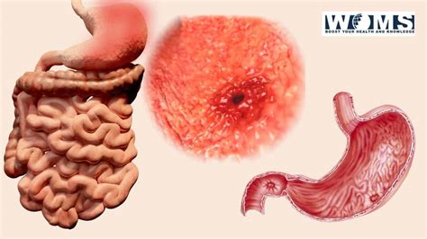 Important Signs Of Stomach Ulcer Causes And Treatment