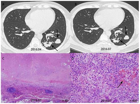 Comparative Study Of Primary Pulmonary Cryptococcosis With Multiple