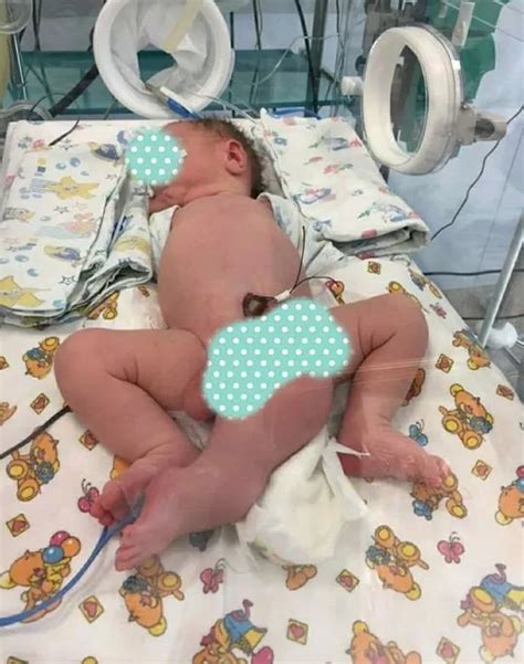 Baby Born With Legs Penises And No Anus After Twin Didn T Form In