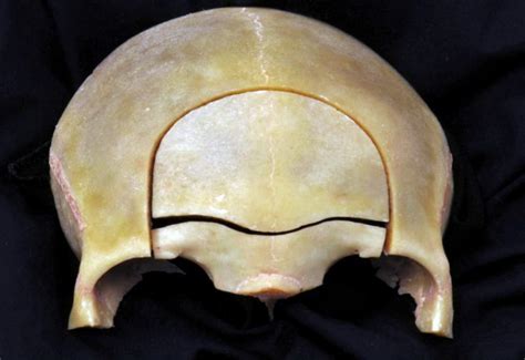 Anterior View of the Frontal Bone and Superior Margin of the Orbit ...