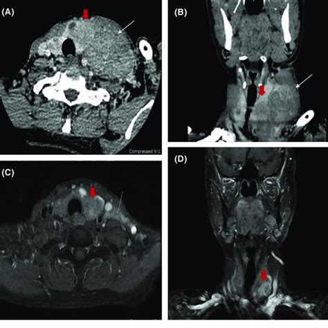 A Contrasted Ct Scan Of The Neck Multiple Hypoechoic Nodules In Both