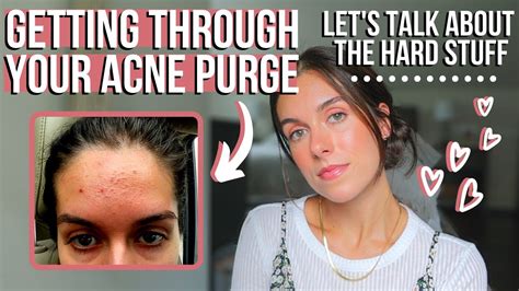 Getting Through Your Tretinoin Purge Tips For Your Mental Health And