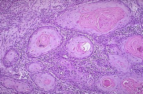 Pathology Cervix Squamous Cell Carcinoma
