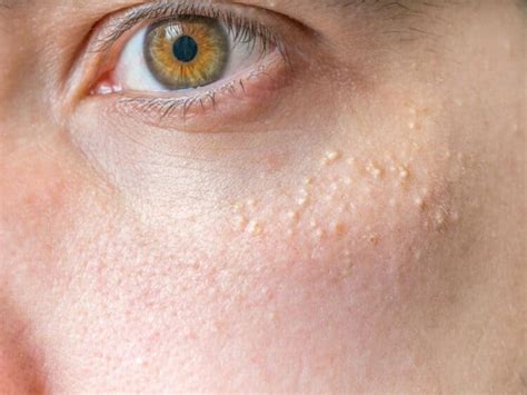 Small White Spots On Skin Little Dots Bumps Face Legs Remedies