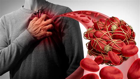 What Is A Blood Clot Causes Symptoms And Treatment