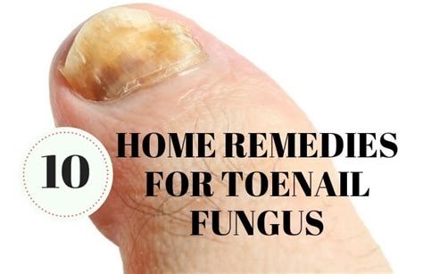 10 Simple And Natural Home Remedies For Toenail Fungus