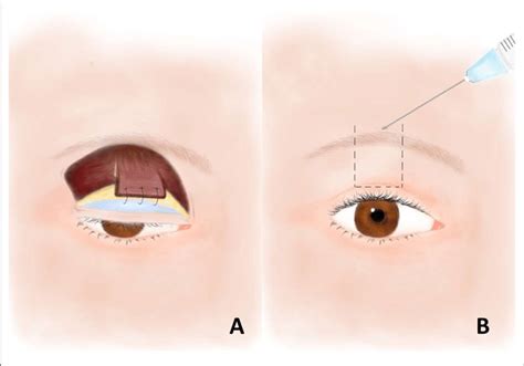 A The Frontalis Orbicularis Oculi Muscle Foom Flap With The