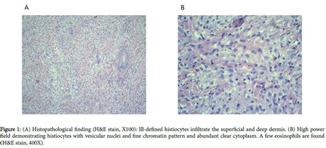 Clinical Experimental Dermatology Research Histopathological Finding