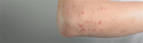 Viral Skin Conditions In Oregon And Washington Silver Falls