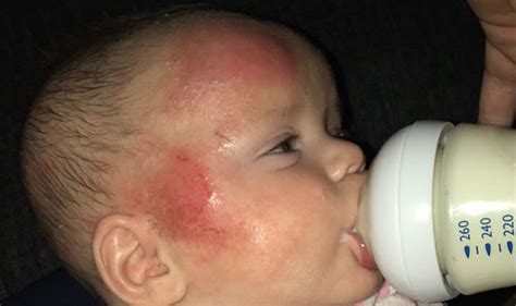 Healing Eczema How To Treat Infant Eczema Naturally