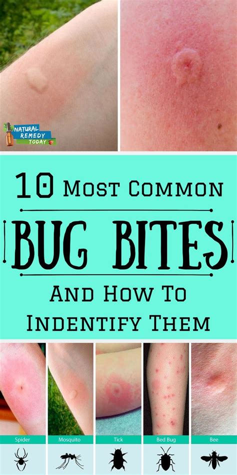 10 Most Common Bug Bites And How To Identify Them Bug Bites Remedies