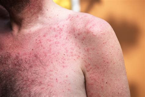Heat Rash All You Need To Know In 8 Photos