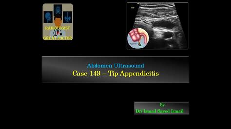 Ultrasound Case 149 Tip Appendicitis Youtube
