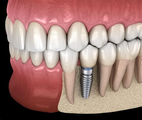 A Step By Step Guide To Dental Implants Bella Dental