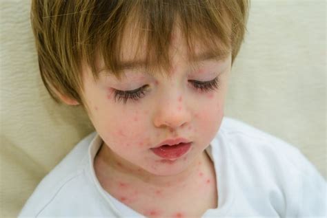 Understanding Chickenpox Causes Symptoms And Prevention Facty Health
