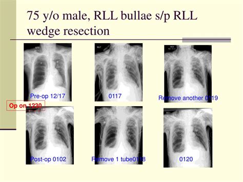 Ppt Subcutaneous Emphysema Associated With Chest Tube Drainage Respirology