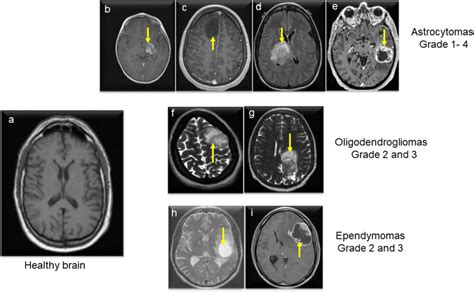 Mr Imaging Of The Different Types Of Glioma Astrocytoma Download