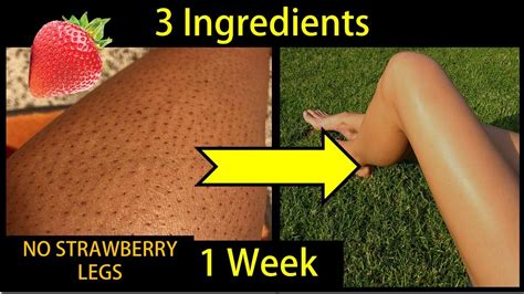 How To Get Rid Of Strawberry Legs Ingrown Hairs In Week