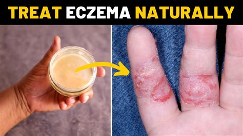 Cure Eczema Permanently On Hands And Fingers Fast Using This Homemade