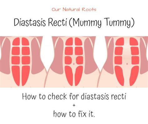 Diastasis Recti Tummy Separation Vanea Posture Pelvic Floor Vrogue
