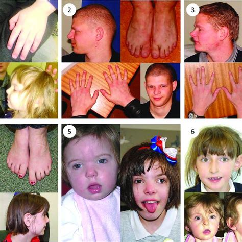 Clinical Photographs Photographs Of Individuals 16 Taken At Ages 3