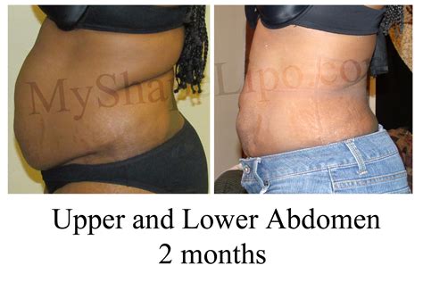 Liposuction Takes The World By Storm Now Considered The Most Popular