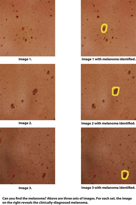 How To Detect Cancerous Moles How To Tell If A Mole Is Cancerous