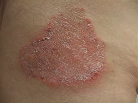Radiation Port Dermatophytosis Tinea Corporis Occurring At The Site Of