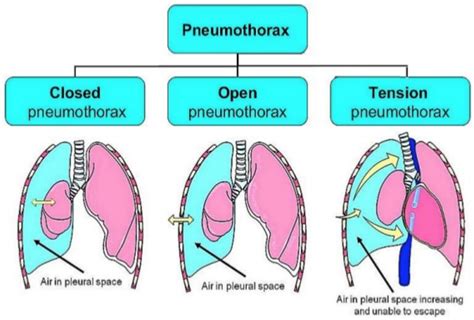 Perbedaan Tension Pneumothorax Dan Open Pneumothorax