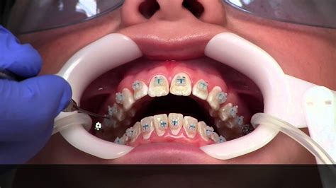 Youtube How To Put Wax On Braces Getting Your Braces Put On Youtube Full Leg And Brazilian