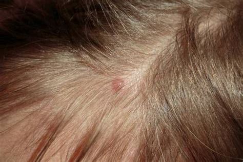 Pimples On Scalp Will Vanish In No Time By Using These 5 Amazing Home